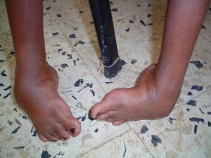 Mozambique Clubfoot